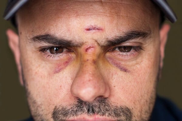 Cuts and Bruises: Can You Recover Benefits in Minnesota